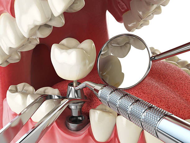 Best Emergency Tooth Extraction in Oakbrook, KY